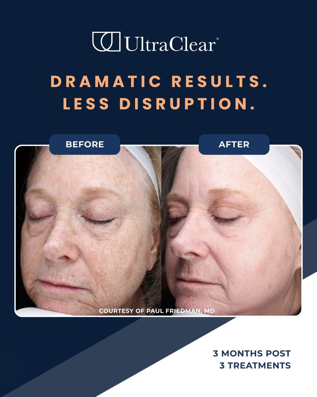 UltraClear Before and After photos 5