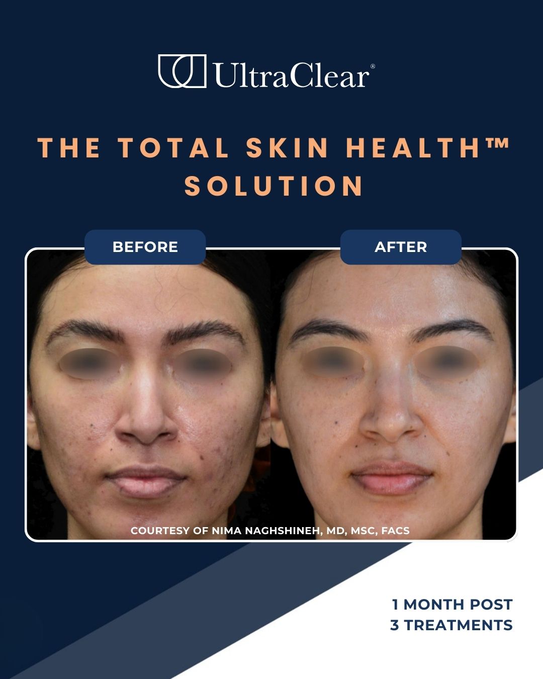 UltraClear Before and After photos 4