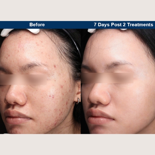 UltraClear Before and After photos 1